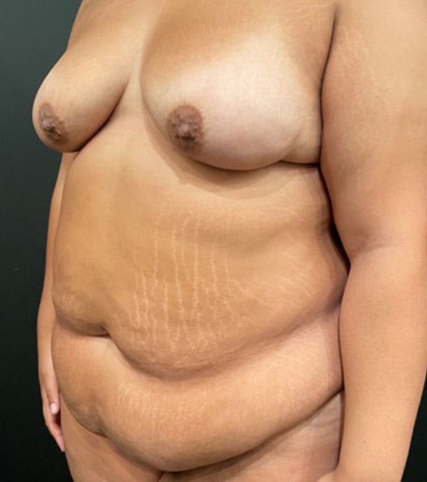 Before Image: Tummy Tuck - left-front-oblique
