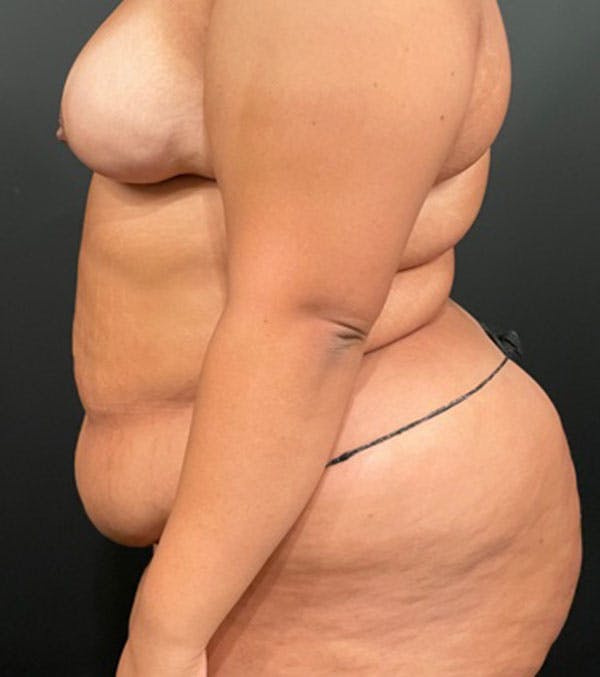 Before Image: Tummy Tuck - left-side