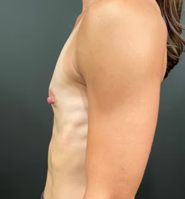 Before Image: Breast Augmentation - left-side