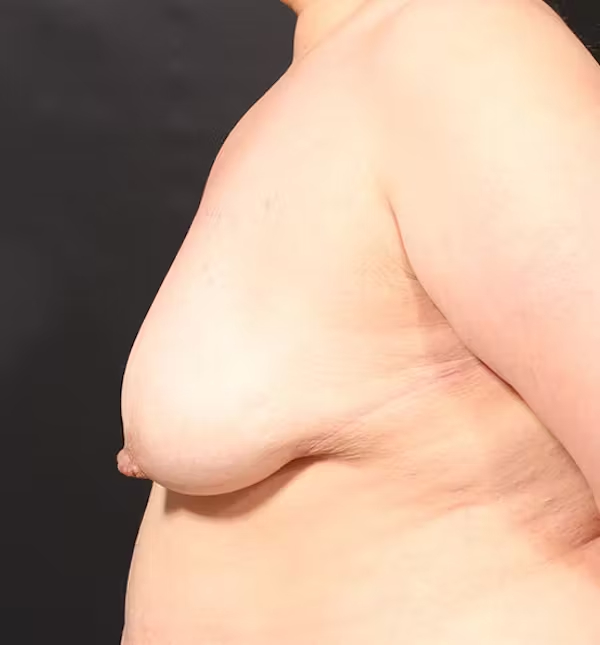 Breast Lift Mastopexy