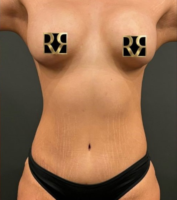 Plus-Size Tummy Tuck®