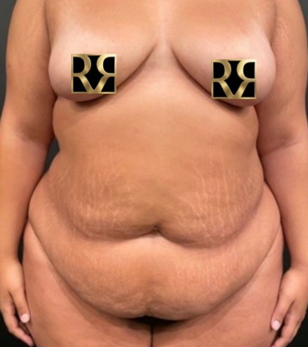 Plus-Size Tummy Tuck®