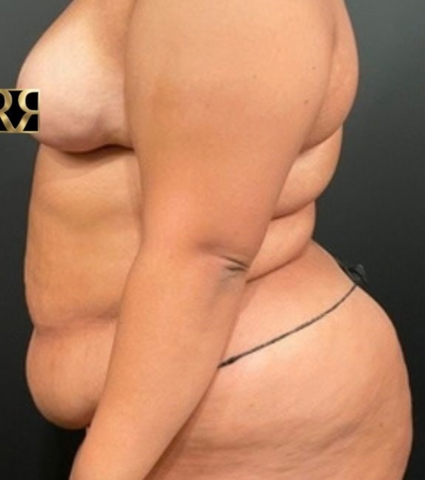 Plus-Size Tummy Tuck®