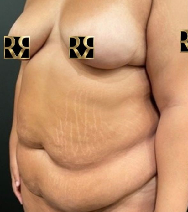 Plus-Size Tummy Tuck®