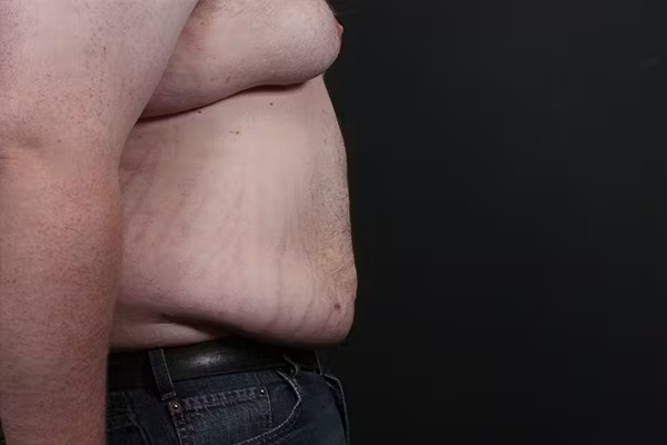 Liposuction