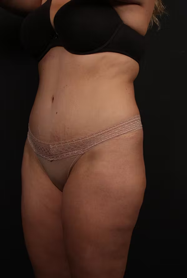 Liposuction