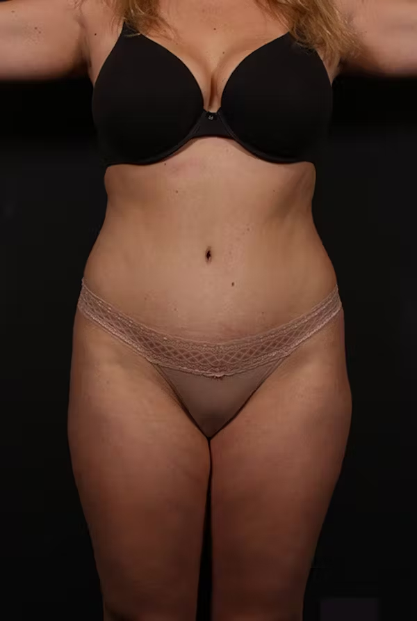 Liposuction
