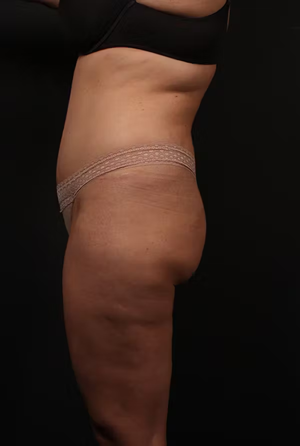 Liposuction