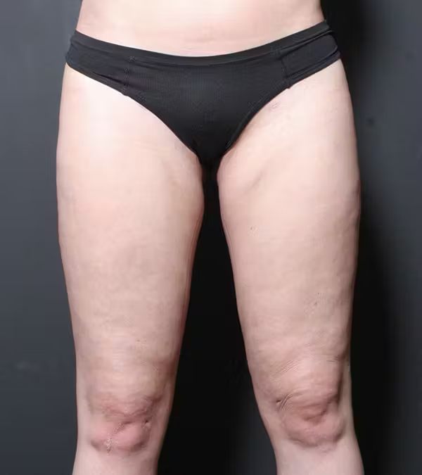Liposuction