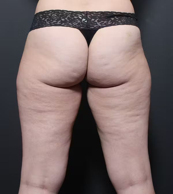 Liposuction