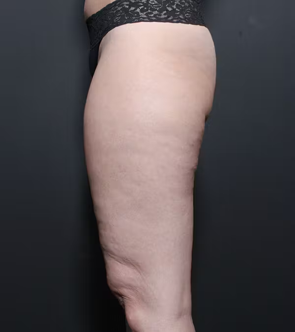 Liposuction