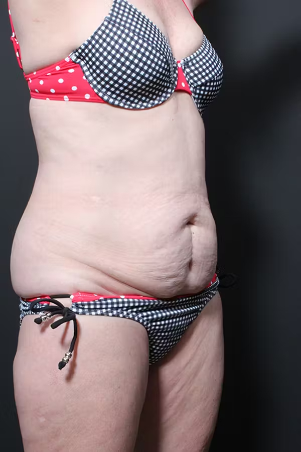Liposuction