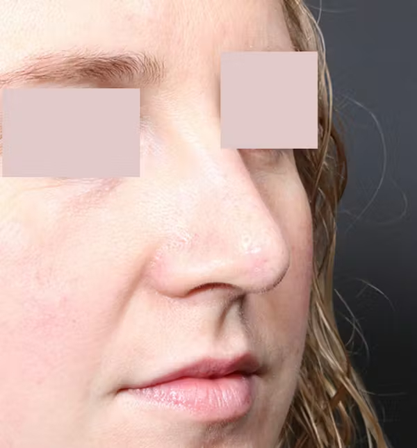 After Image: Rhinoplasty - right-front-oblique