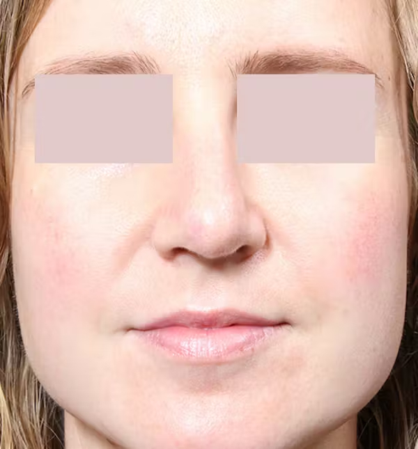 After Image: Rhinoplasty - front