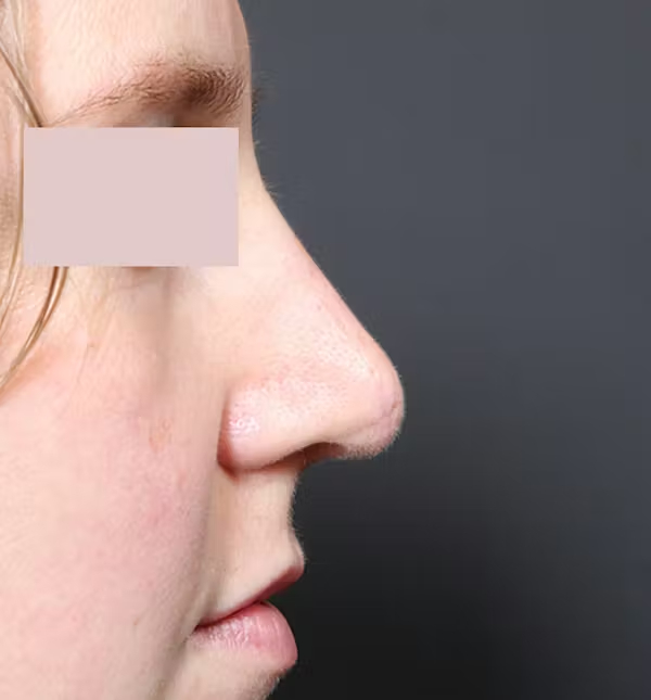 After Image: Rhinoplasty - right-side