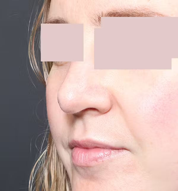 After Image: Rhinoplasty - left-front-oblique