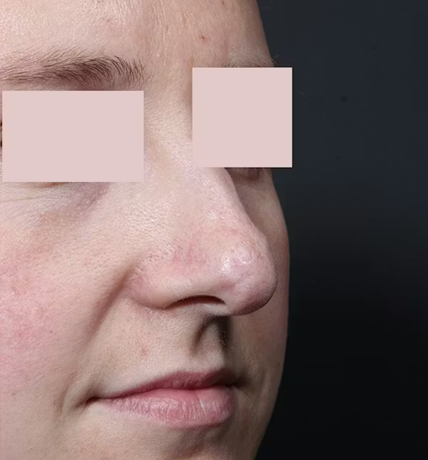 Before Image: Rhinoplasty - right-front-oblique
