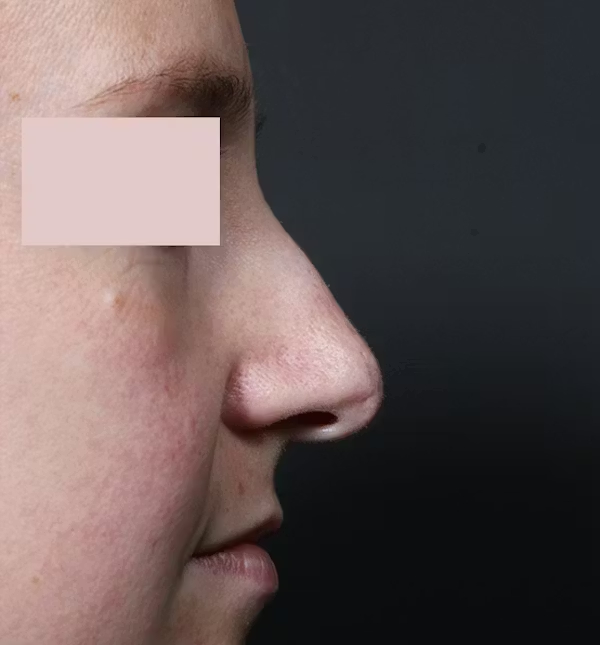 Before Image: Rhinoplasty - right-side