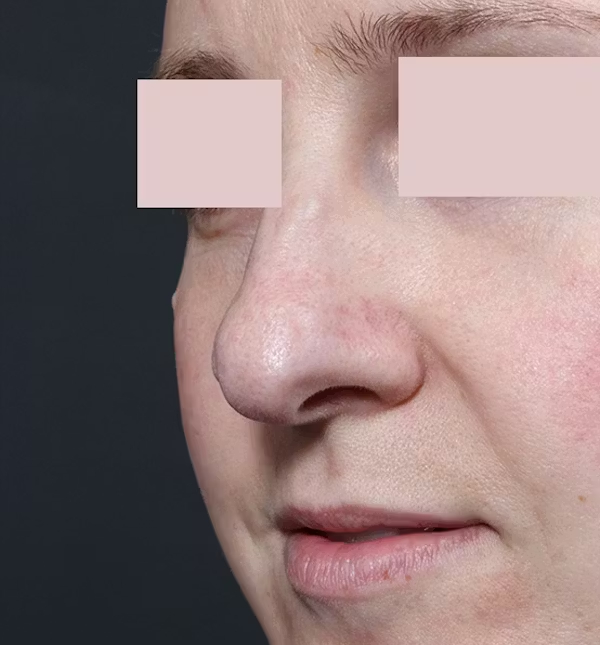 Before Image: Rhinoplasty - left-front-oblique