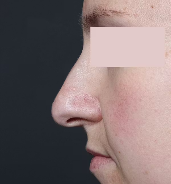 Before Image: Rhinoplasty - left-side