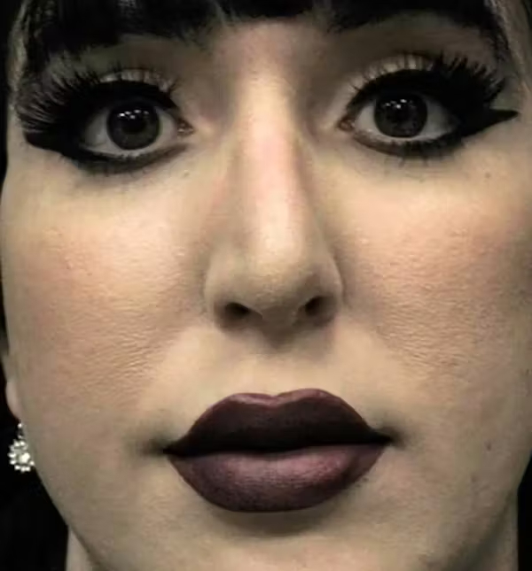 After Image: Rhinoplasty - front