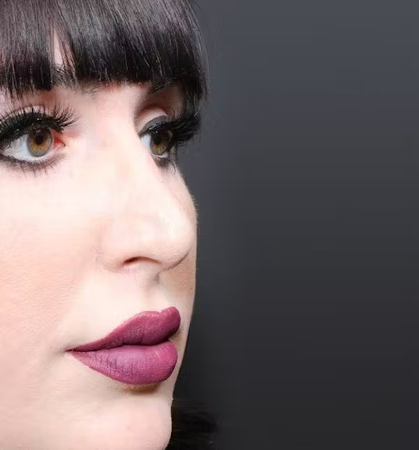 After Image: Rhinoplasty - right-front-oblique