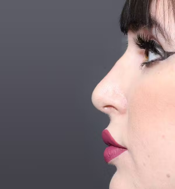 After Image: Rhinoplasty - left-side