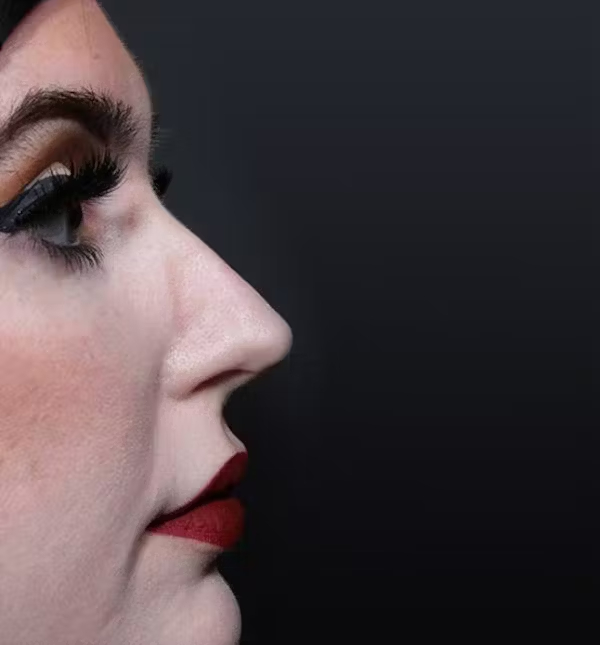 Before Image: Rhinoplasty - right-side