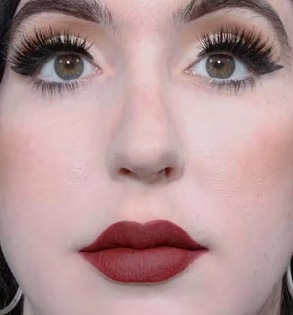 Before Image: Rhinoplasty - front