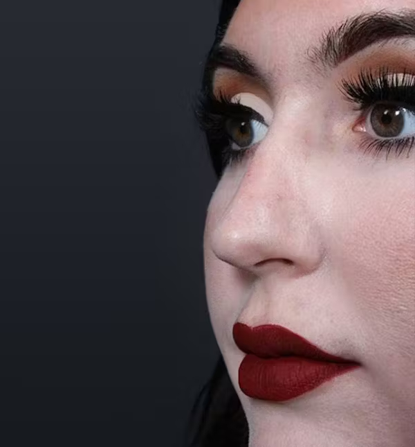 Before Image: Rhinoplasty - left-front-oblique