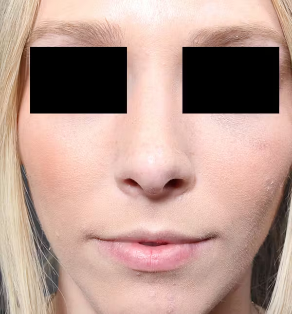 Rhinoplasty