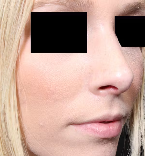 Rhinoplasty