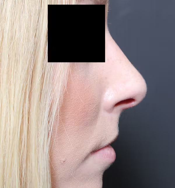 Rhinoplasty