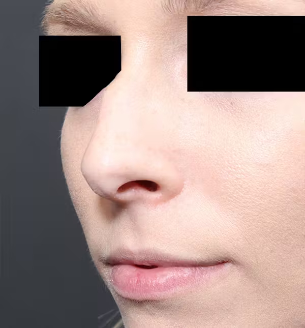 Rhinoplasty