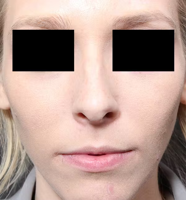 Rhinoplasty