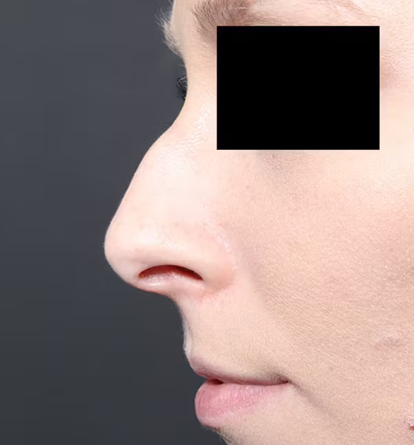 Rhinoplasty
