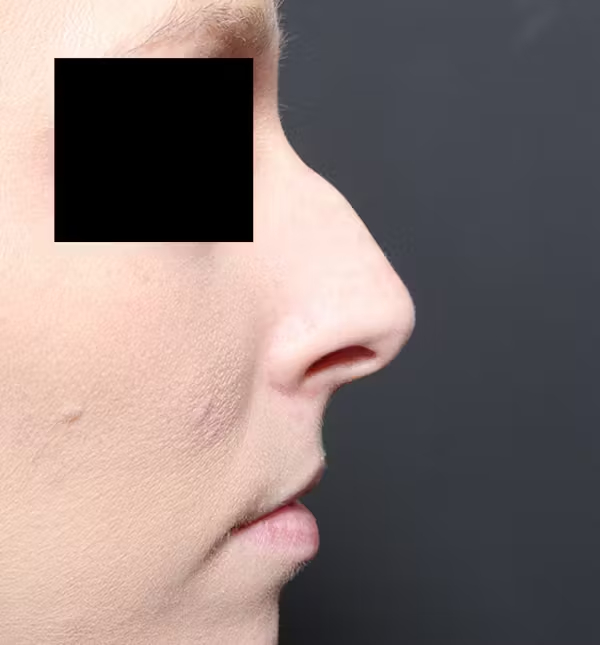 Rhinoplasty