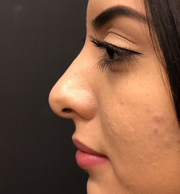Rhinoplasty