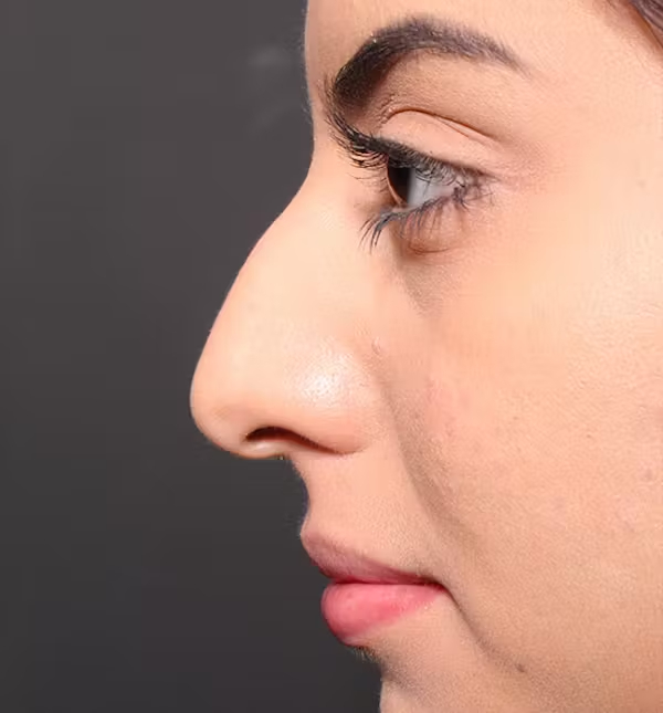 Rhinoplasty