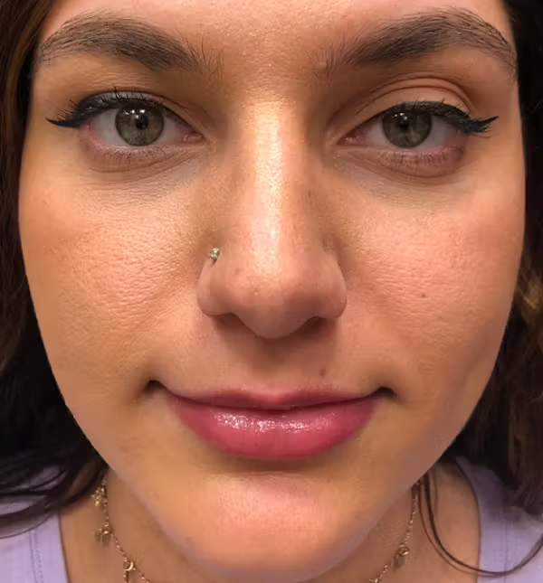 After Image: Rhinoplasty - front