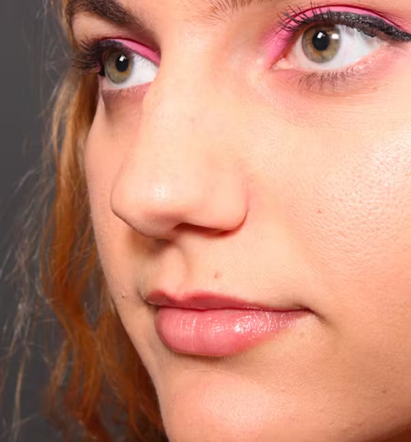 Before Image: Rhinoplasty - left-front-oblique