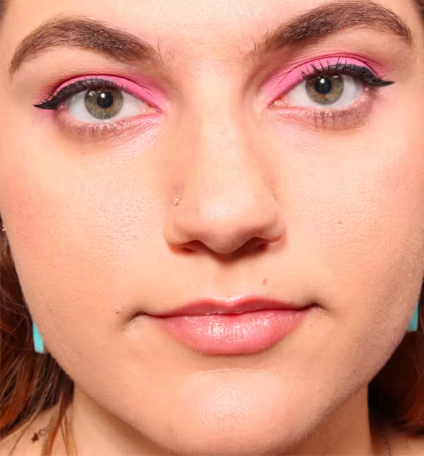 Before Image: Rhinoplasty - front