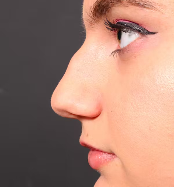 Before Image: Rhinoplasty - left-side