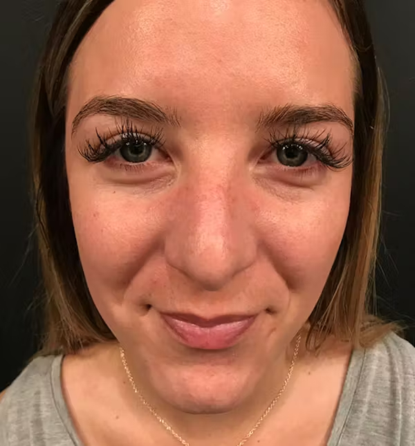 After Image: Rhinoplasty - front