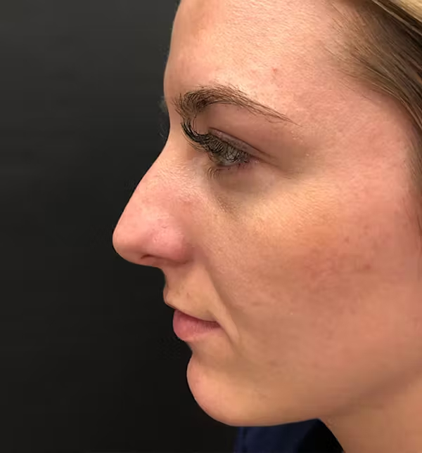 Before Image: Rhinoplasty - left-side