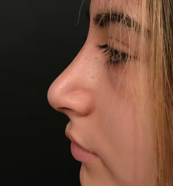 Rhinoplasty