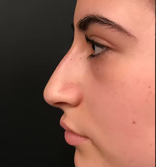 Rhinoplasty