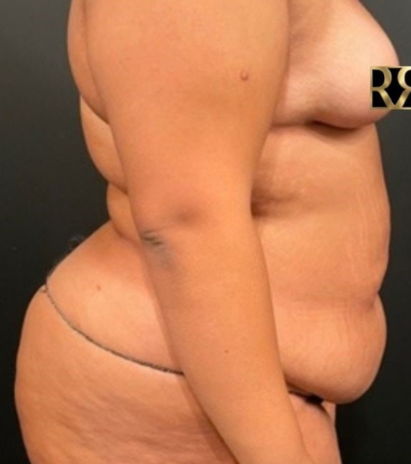 Plus-Size Tummy Tuck®