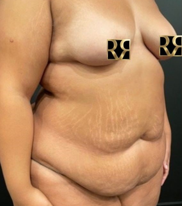 Plus-Size Tummy Tuck®