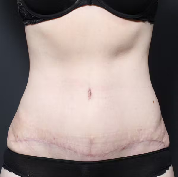 Tummy tuck